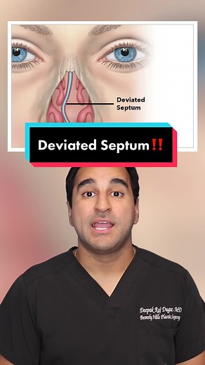 Here are some things to know about a Deviated Septum👃🏽‼️ always get a consultation 1st‼️ . . . #r#rhinoplasticr#rhinoplastikr#rinoplastiar#rinoplastir#rinoplasticar#rhinoplastier#rhinoplastyexpertb#bestrhinoplastyn#nosejobn#nosejobbeforeandaftern#nosejobsn#nosejobdiaryp#plasticsurgeryp#plasticsurgerybeforeandaftera#aestheticsurgeryb#beverlyhillsrhinoplastya#aesthetica#aestheticsc#cosmeticsurgeryc#cosmeticsf#facialplasticsurgeryb#beforeandafterb#beforeafterb#beautyr#revisionrhinoplastya#asianrh