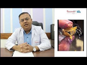 TAVI Procedure Explained by Dr. Nitin 👨‍⚕️ | Heart Valve Treatment #heart #doctor #shorts