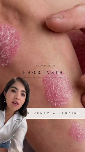 Understanding Psoriasis: Causes and Contagiousness Explained