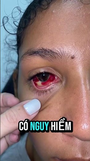 🚨 RED IN EYES? Don't ignore this sign! 👀