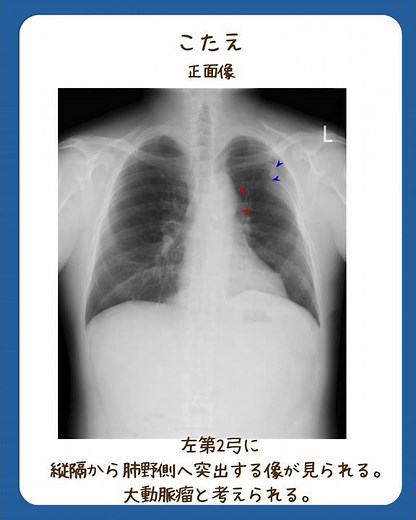 胸部レントゲン 一問一答 #2