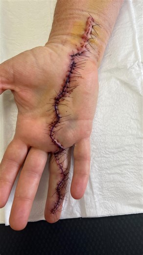 Upper Limbs & Beyond 💪🏻🦵🏻 on Instagram: "When a major scar heals so beautifully 😍 Everyone’s healing time can vary depending on a few factors but most scars will heal nicely within a 6-12 week period! Scar management will be your best friend in the healing process! #upperlimbsandbeyond #handtherapy #mackayhandtherapist #lymphoedematherapy #occupationaltherapy #scaring"