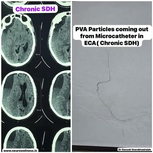 How We Treated a Brain Bleed While Continuing Blood Thinners