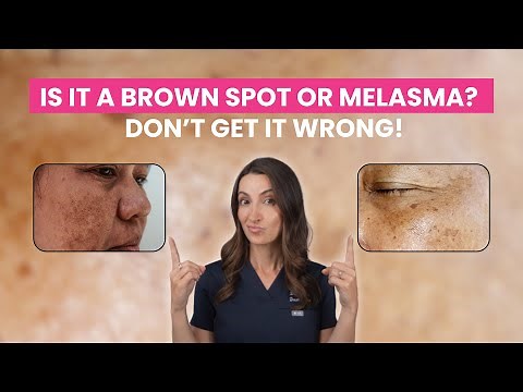 Brown Spots vs. Melasma: How to Tell the Difference & Treat the Right Way | Derm-Approved Guide