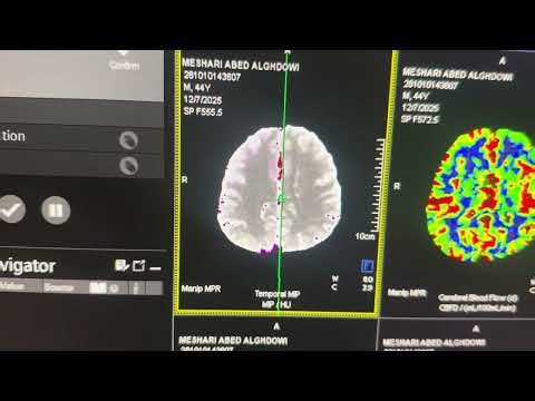 Perfusion post processing