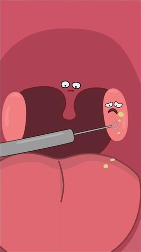 The SHOCKING Truth About Tonsil Stones and Bad Breath #animation #tonsilstones #badbreath