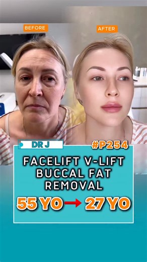 Dr J by ABmedi (Kim Jeong) on Instagram: "📳 WhatsApp: (+84)-975-142-666: Free Consultation ✅ Scarless Facelift ✅ Forehead lift ✅ Buccal Fat Removal ✅ H.A Collagen - 14 days after surgery ⏰ 21 days after surgery and H.A 💉 Under local anesthesia #faceliftbeforeandafter #buccalfatremovalbeforeandafter #fillertreatment #drj #drjeongwon #antiagingsolution #rejuvenationfacial #facialrejuvenationtreatment"