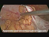 Laparoscopic Solitary Caecal Diverticulectomy • Video • MEDtube.net