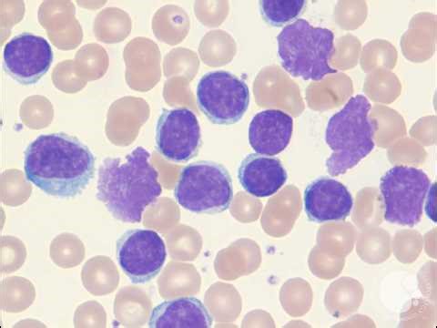 Chronic Lymphocytic Leukemia (CLL): Workup and Management