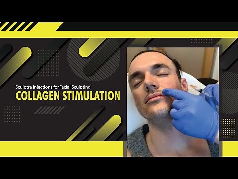 Sculptra Injections for Facial Sculpting | Collagen Stimulation | Dr. Jason Emer | LIVE