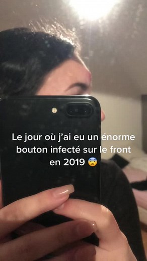 C’était horrible😭😭😭 désolée pour les images choquantes j’ai honte 😂 #pourtoi #foryou #fypシ #bouton #furoncle #fakebody #warning #beurk #button