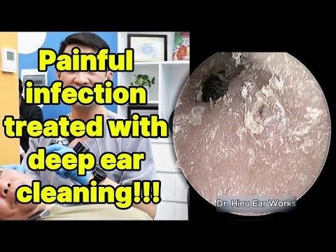 Painful infection treated with deep ear cleaning | ear cleaning | ASMR earwax | soothing |relax|