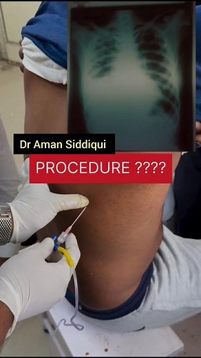 Comment Procedure #dramansiddiqui #medical #medicalprocedure #pleuraleffusion #doctor #lungs