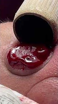 Acne Treatment Mai Ngoc #điềutrịmụnđànẵng #pimple #acne #blackheads #acnetreatments