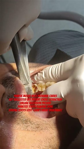 Severely Painful Molar Tooth Extraction | RCT Option Refused. Painless Tooth Removal 🦷#TheDentalGuru