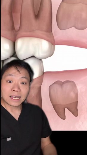 Understanding Wisdom Teeth Impaction and Infections