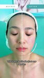 Best Non-Invasive Anti-Wrinkle Face Lift | Victoria Facelift