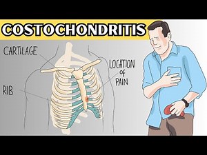 Costochondritis - Causes, Signs And Symptoms, Diagnosis, And Treatment