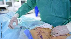 Doctor is inserting medicines into patient's belly with the help of big syringe. Plastic liposuction surgery of female abdomen.
