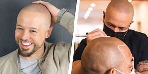 Hairline Tattooing Might Be The Hair Loss Solution You Didn’t Know Existed