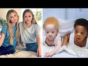 10 Most Unusual Twins You Won’t Believe Exist!