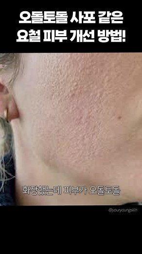 정성들여 피부 화장을 해도 오돌토돌 거칠어보여 스트레스 받는 분들 계시죠? 이런 경우 좁쌀여드름 혹은 모낭충증이 원인일 수 있는데요🔎 오늘은 울퉁불퉁한 요철피부 해결법에 대해 알려드릴게요! ✔️요철피부 개선법이 궁금하다면 피부영유앤영 유튜브🎥에서 확인해보세요💚 💻피부영유앤영 유튜브 채널 youtube.com/@youryoungskin #요철피부 #좁쌀여드름 #피부관리 #피부영유앤영 #유앤영피부과 #유앤영유튜브 #틱톡교실 #틱톡쌤 #틱톡쌤지영쌤 #피부과지영쌤