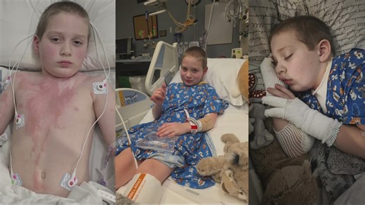 Family warns parents after toy explosion leaves 7-year-old with severe burns