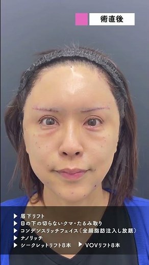 50歳女性、見た目年齢30代を目指してジェントル式若返り整形❗️