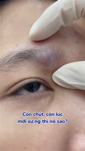 52K views · 155 reactions |  It looked small, but wait till you see the ending! | Pimple Popping | Facebook