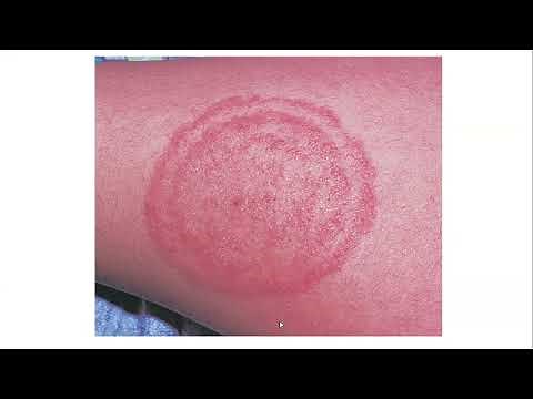 Lecture-136: Dermatophyte infections. Rook's chapter 32.