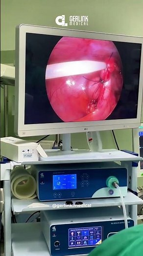 DETIK-DETIK PEMOTONGAN USUS BUNTU