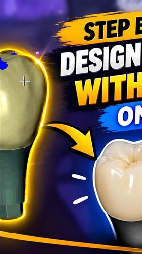 🦷 Learn how to design a custom premolar and an overlay crown in exocad — step by step! 💻✨