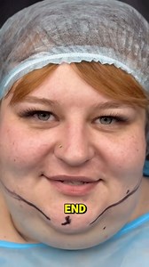This woman changes 180 degrees after her double-chin surgery. Watch the full video in comments 👇👇 | Interesting Stories