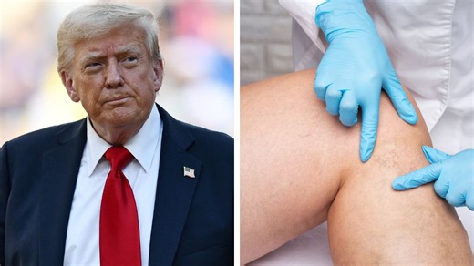 Chronic Venous Insufficiency Early Warning Signs—Including Trump's Red Flag