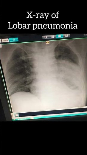 X-ray of pneumonia | x-ray of lobar pneumonia #pneumonia #xray #medical #medicalstudent