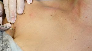 Surgery concept. Electrocoagulation of papillomas. Close-up shot of doctor burns papillomavirus with medical tools and equipment on female body. Papillomas removal. 4 k footage