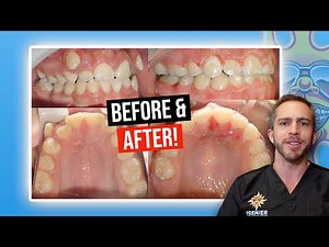BRACES BEFORE & AFTER: Crowding with Missing Teeth