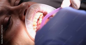 Female patient with mouth retractor during treatment in dentist office. Dentist's tools and treatment and teeth whitening