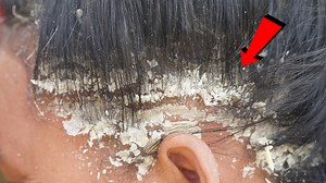 366K views · 1.7K reactions | Extreme Damage Dandruff - Dandruff combing and scratching -Itchy Dry scalp 287 | 33K | Facebook