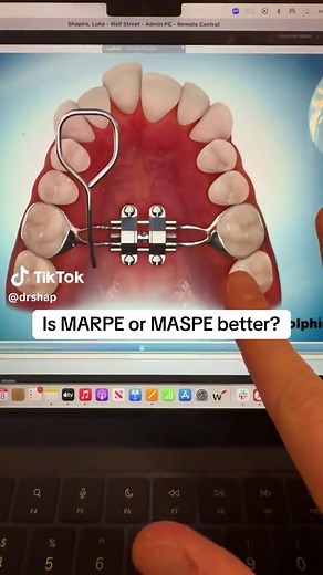 When we talk about MARPE, I am referring to the actual palatal expansion device with the screws. MASPE refers to the turning protocol using the same device. I would say most providers that are up to date are doing this slow turning protocol. You avoid the diastema and it’s better for the bone/tissue. FME is a type of noncustom MARPE. Each patient is different and some may require cuts, some may need 4 screws, some made need 6. There is no single best way. At the end of the day, you just need to