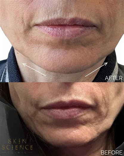 Skin Science Clinic on Instagram: "Our patient has kindly shared her before-and-after results following her first Profhilo Structura treatment. This injectable bioremodelling procedure has already delivered a visible improvement in lower-face laxity — an area that had been impacting her confidence. Dr Sarwar performed this procedure using a cannula, placing the gel along the mandible and injecting into the superficial fat compartment of the pre-auricular area. She will return in four weeks for h