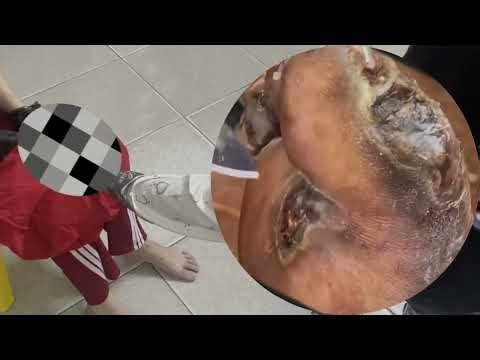 🤯 Jigger Infestation Horror – Skin Full of Parasites #CU146