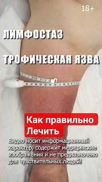 Как лечить трофическую язву при лимфостазе? Результат До После. Многослойный бандаж. Флеболог Москва