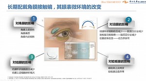 眼科杨晓教授讲解《OK镜相关眼表并发症的筛诊治》