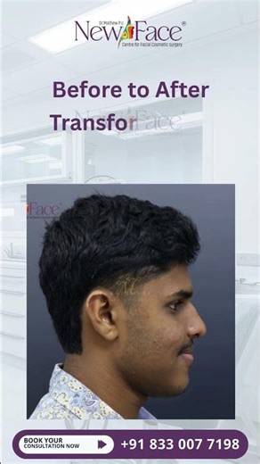 Jaw Surgery Transformation in India | Before & After Results by Dr Mathew PC