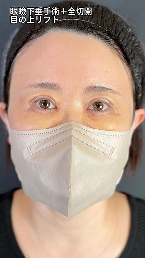 眼瞼下垂はダウンタイムがひどい？そうでもありません。二重で切開しても大丈夫。40代女性の切開法眼瞼下垂手術。 #眉下切開 #眉下リフト #眼瞼下垂