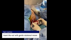 Treatment of Proximal Humerus Fractures With a Percutaneous Nail