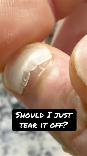 You asked what happened to my finger… this is your answer 😬