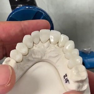 1K views · 35 reactions | This is what 10 units Zirconia, Hollywood Smile Makeover looks like | Dr. Ali Rashid | Facebook