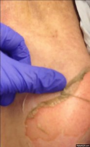 nikolsky's sign on Make a GIF